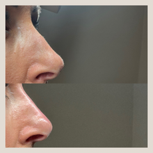 Load image into Gallery viewer, Non-surgical Rhinoplasty